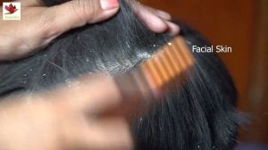 Dandruff and Huge Flakes Scratching, Itchy dry scalp #683