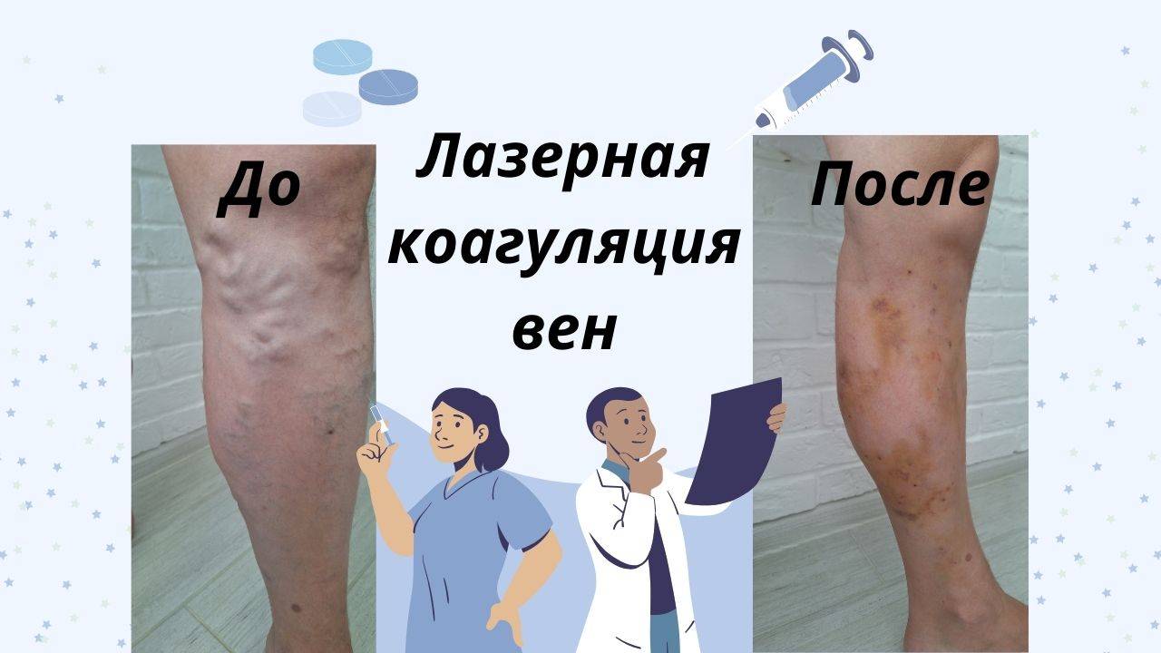 Лазерная коагуляция, варикозное расширение вен смотреть онлайн