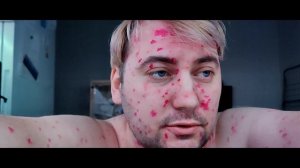 ВЕТРЯНКА В 31. Чем опасна эта болезнь во взрослом возрасте?