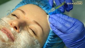 Как убрать морщины на лице ✦  Филлер Белотеро✦   Бланшинг➤