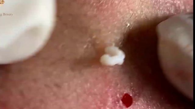 Удаление черных точек 2021 - Remoção de cera de ouvido 2022 EP006 смотреть онлайн