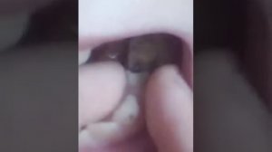 у меня шатается коренной зуб