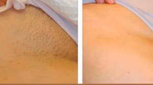 Ни единого волоска как подготовиться к лазерной эпиляции