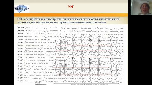 Epilepsiya 1 kismi смотреть онлайн