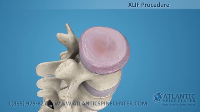 Extreme Lateral Interbody Fusion (XLIF) Procedure смотреть онлайн