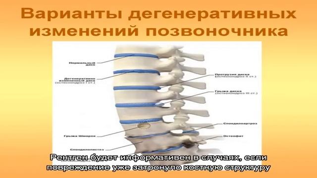 Дегенеративные изменения менисков
