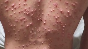 Ветрянка симптомы у взрослых