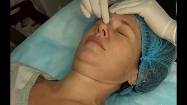 Химический пилинг век смотреть онлайн