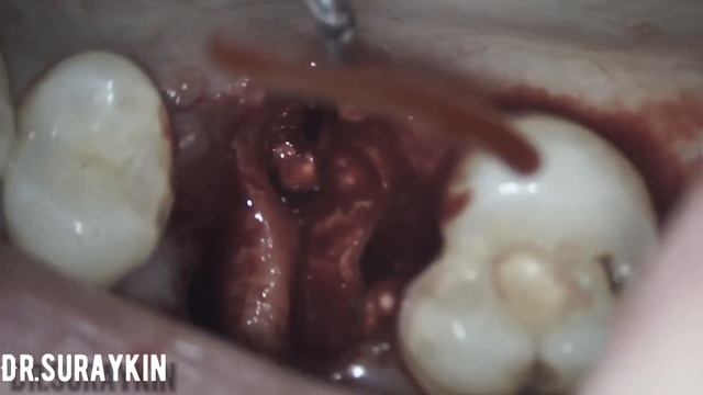 Удаление зуба , вырвать зуб , на приеме у стоматолога , пошли к стоматологу , киста в зубе . смотреть онлайн