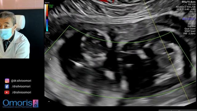 Gravidez de GEMEOS. Ultrassom obstétrico de 13 semanas. смотреть онлайн