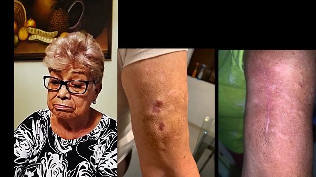 Testimonio Cáncer De Piel. Salud Con GANODERMA LUCIDUM