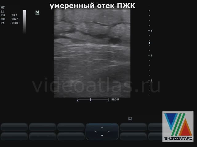 Отек ПЖК смотреть онлайн