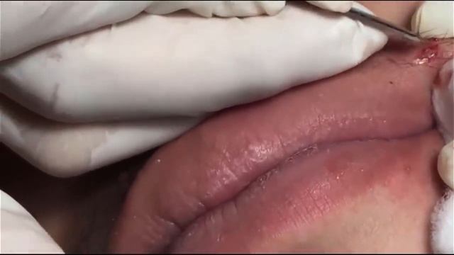 Выдавливаем прыщи и черные точки смотреть онлайн