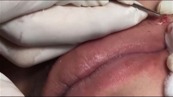 Выдавливаем прыщи и черные точки