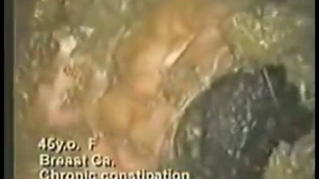Видео Кишечника. Жесть! смотреть онлайн