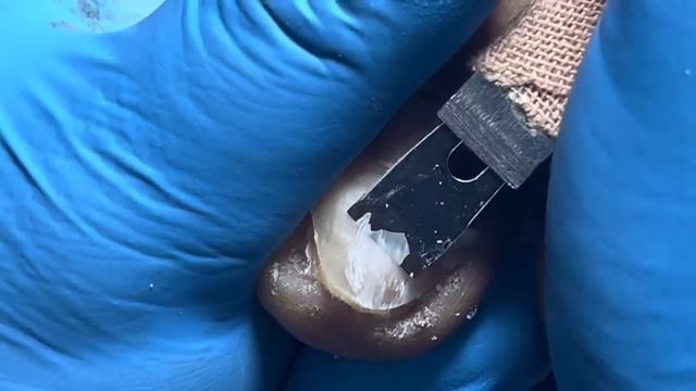 Nails crazily inserted inwards, pull out the nails vigorously【Pedicure Master Lin Jun】 смотреть онлайн