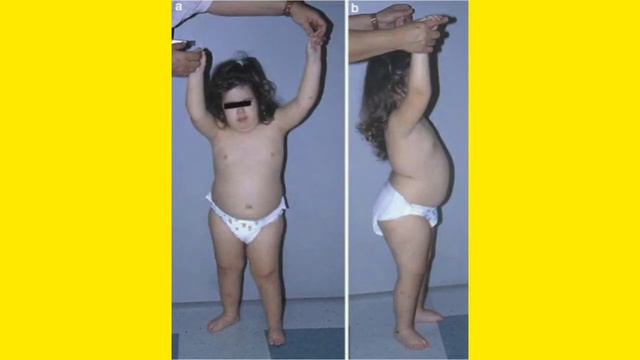 Prader Willi Syndrome | Dr Shahan's Class #NEXT #NEETPG #INICET #DNB