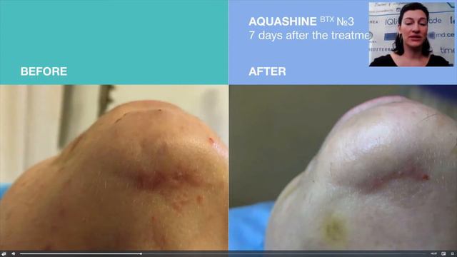 WEBINAR AQUASHINE BTX - Hydratácia-Depigmentácia-Rekonštrukcia Relaxácia Pleti V Estetickej Medicín