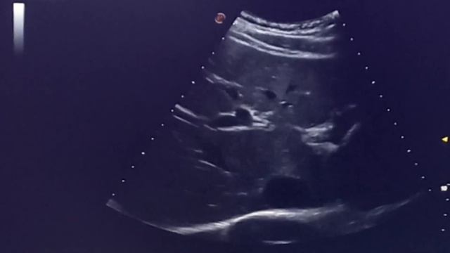 УЗД симптом «звездного неба» характерную для  гепатита