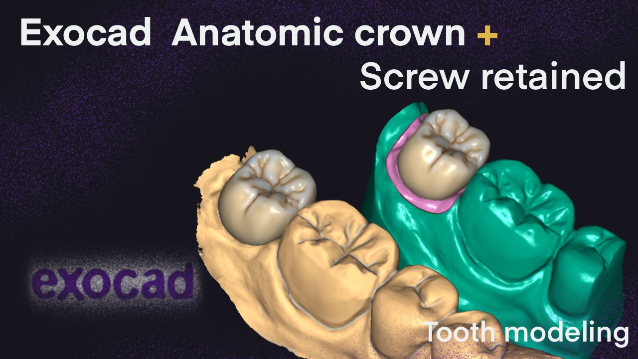 Exocad  Anatomic Crown + Screw Retained I Tooth Modeling 6