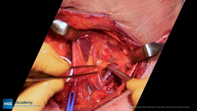 Brachial Plexus Supra-clavicular Anatomy: A Cadaveric and Intra-operative Correlation смотреть онлайн