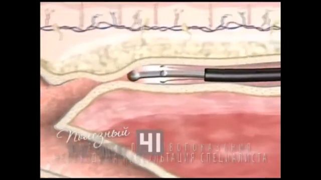 Варикоз у мужчин лечение Как лечить варикоз на ногах у мужчин Варикоз яичек у смотреть онлайн