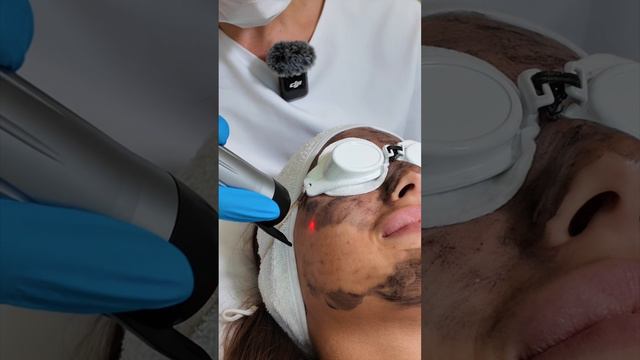 Карбоновый пилинг - как проводят процедуру в клинике косметологии GEN87 | Неодимовое омоложение смотреть онлайн