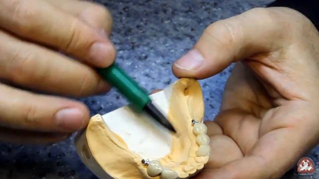 Бюгельный протез смотреть онлайн