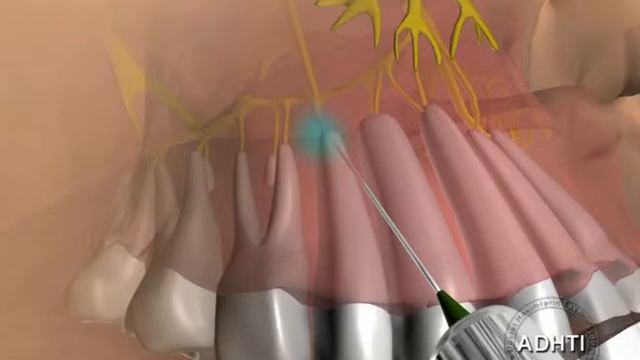 шечные инфильтрационная анестезия моляров...antiplaque infiltration anesthesia molars смотреть онлайн
