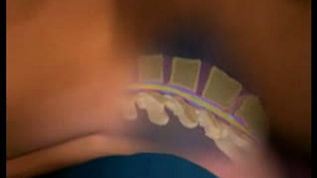 Спинномозговая пункция