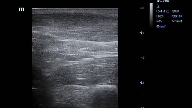 Тендинит ахиллова сухожилия с гиперваскуляризацией смотреть онлайн