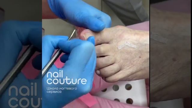 Вросший ноготь. Установка тампонады. смотреть онлайн