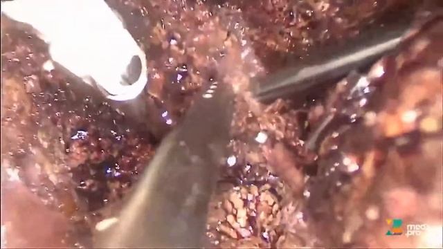 Лапароскопическая правосторонняя гемигепатэктомия