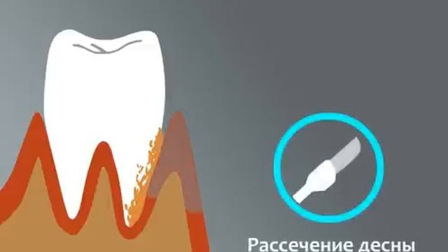 Открытый кюретаж смотреть онлайн