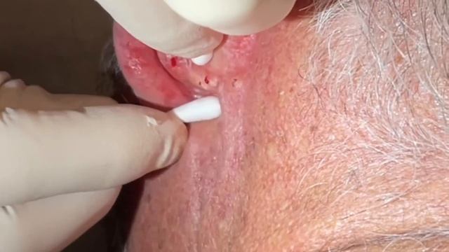 Ear Blackhead extractions. Multiple techniques used for deep embedded dry plugs and cyst pops. смотреть онлайн
