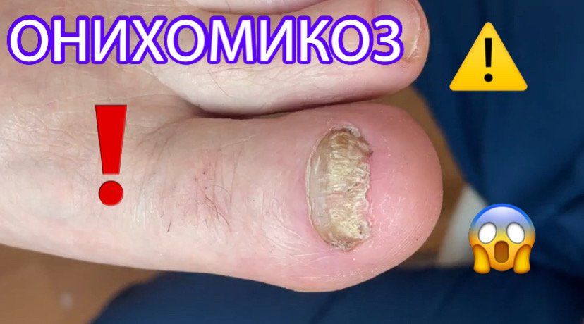 Онихомикоз ?⚠️❗️?? смотреть онлайн