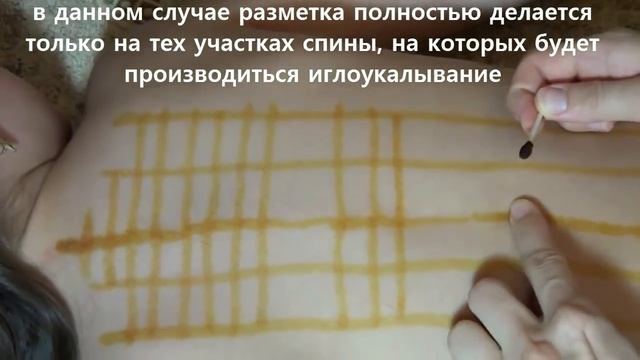 Акупунктура.Постановка игл на спину. www.acupuncture.uz смотреть онлайн