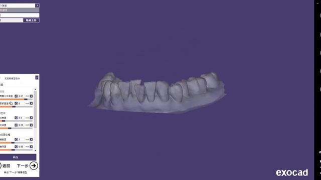 Ortho Model Building With Exocad