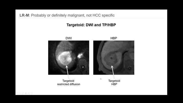 3. LI-RADS: Overview of CT/MR algorithm and major features - Part 1. By Dr. Victoria Chernyak. смотреть онлайн