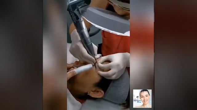 เลเซอร์ Spectra Goldลบรอยสัก สีดำ น้ำตาล แดง รอยสักที่ลงสีทับหลายครั้ง смотреть онлайн