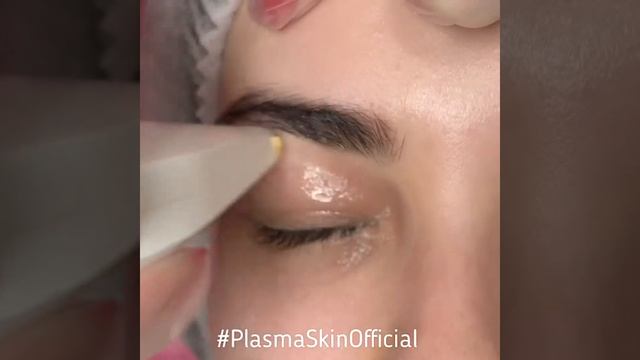 PlasmaSkin аппарат высокочастотной плазмы. Манипула плазменный душ