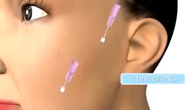 3D мезонити смотреть онлайн