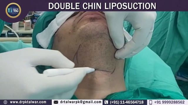 Double Chin Reduction/Removal in Delhi, Cost, Procedure, Result, Chin Liposuction By Dr. PK Talwar смотреть онлайн