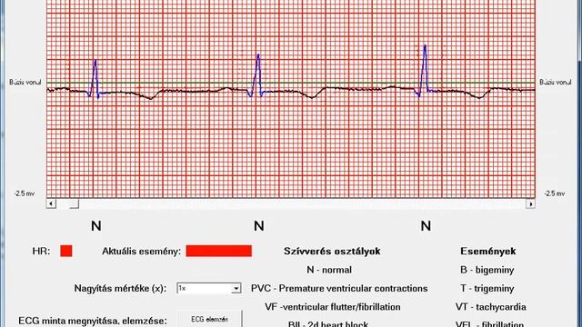 ECG signal processing смотреть онлайн