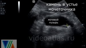 Камень мочеточника