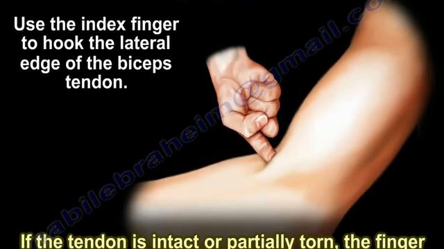 Distal Biceps Tendon Tear, Hook Test - Everything You Need To Know - Dr. Nabil Ebraheim