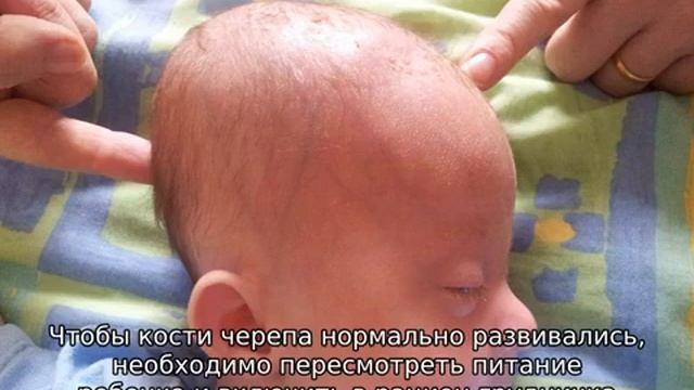 Большой родничок у ребенка — причины и последствия смотреть онлайн