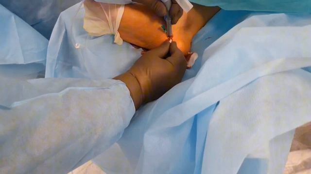 Пяточная шпора и её удаление, без больших разрезов, и быстрая реабилитация. смотреть онлайн