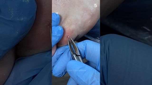 Как убрать стержневую мозоль? Разгрузка для чего нужна? Полная версия видео по ссылке в описании! смотреть онлайн