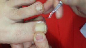 Выросший ноготь. Подкладываем каполин